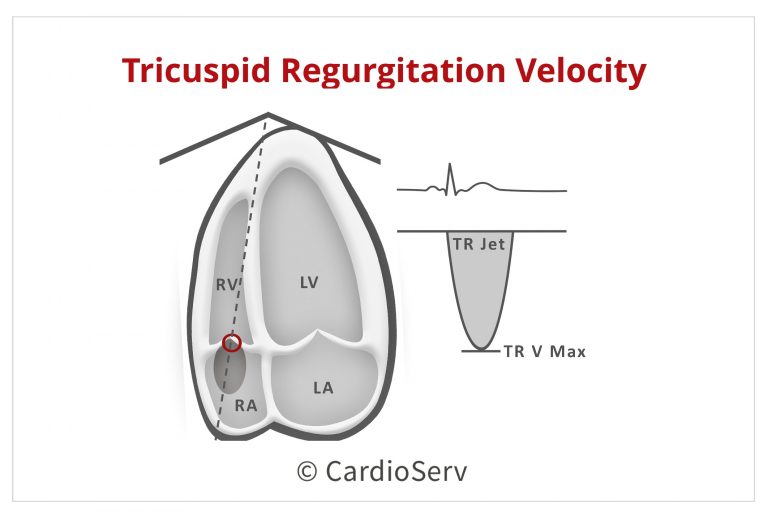 5 Steps to Identify Diastolic Dysfunction in Echo Cardioserv