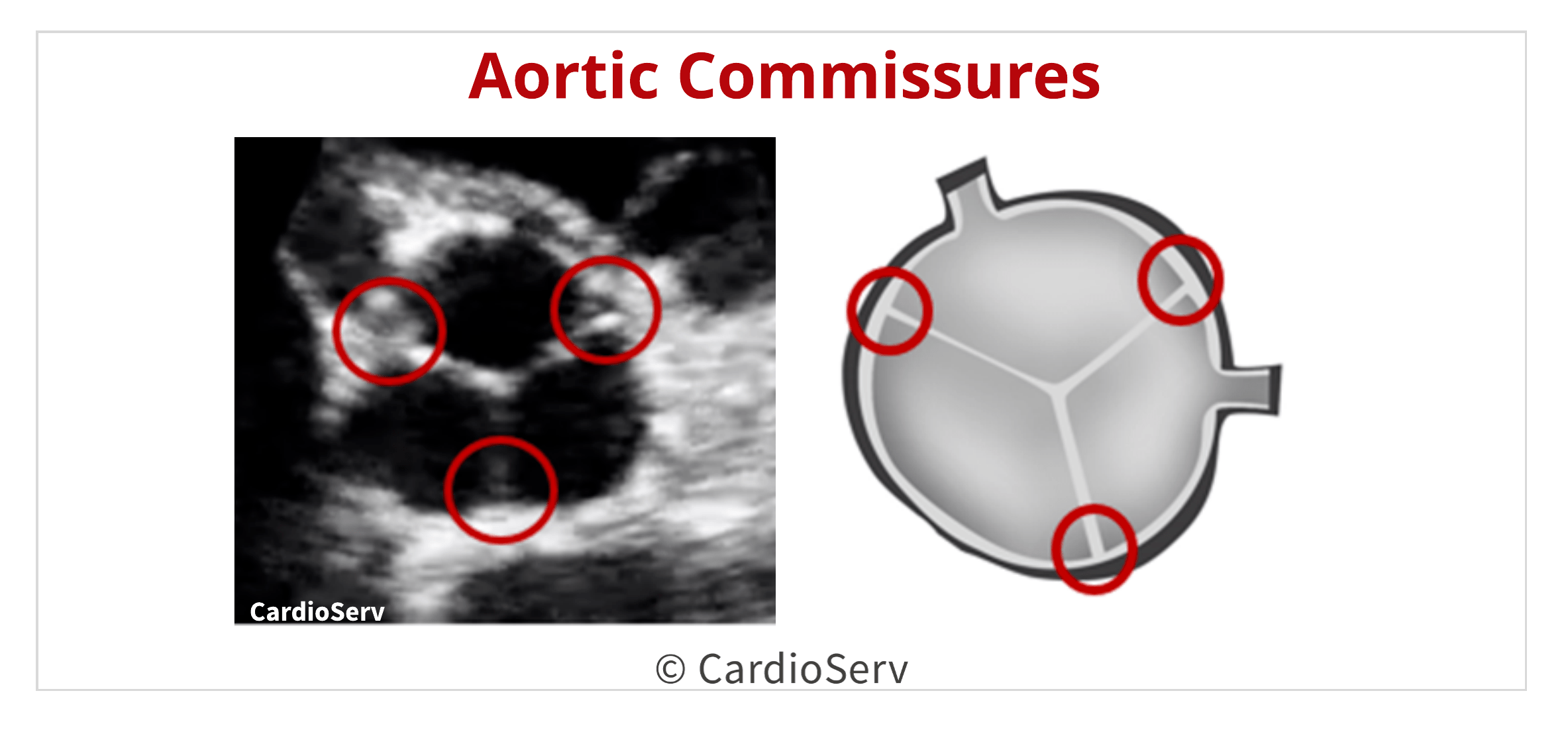 Back to the Basics Aortic Valve Anatomy Cardioserv