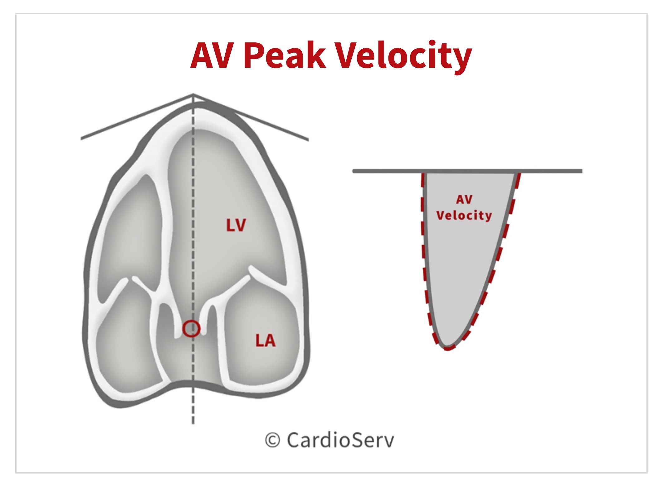 Aortic Stenosis Breaking Down the Continuity Equation Cardioserv