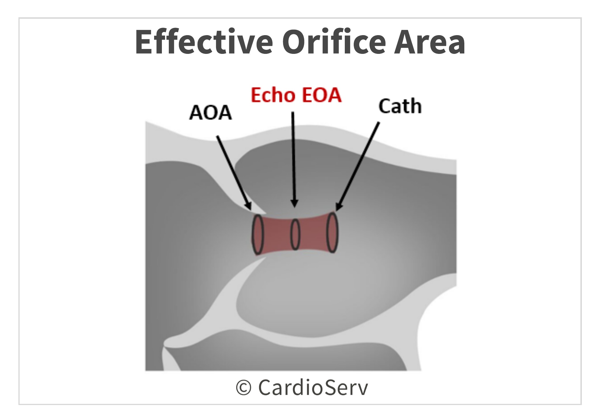 Aortic Stenosis Breaking Down the Continuity Equation