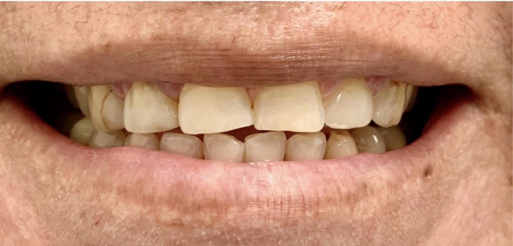 worn down teeth Dr. Gentry