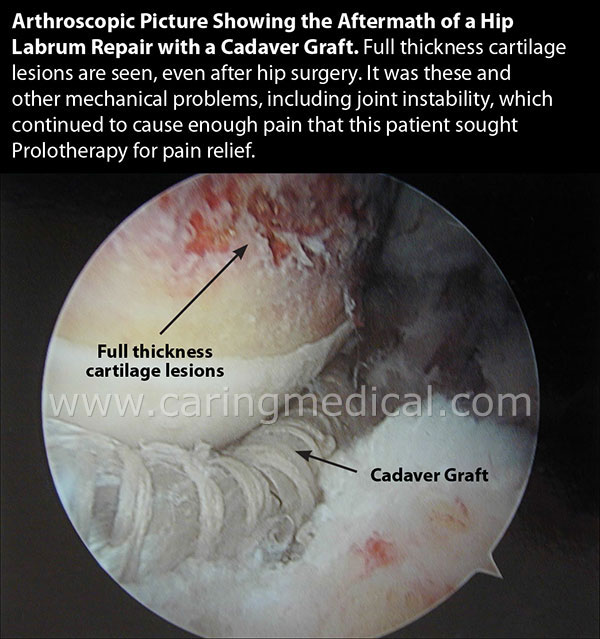 Doctors question Hip Labrum Surgery Others support injection