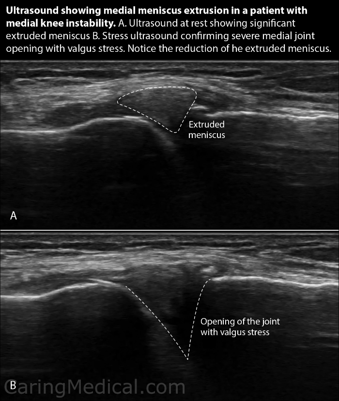 Platelet rich plasma injections for meniscus tears