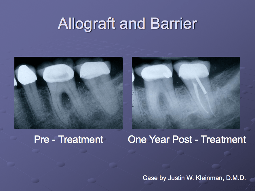Guided Bone & Tissue Regeneration in Westminster MD Save Your Teeth