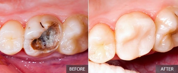 Fillings Composite, Amalgam, Gold, Porcelain Carson & Carson, DDS
