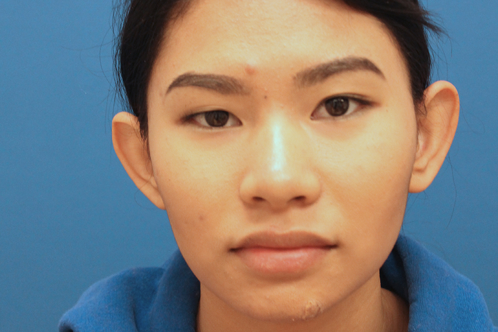 Ear Surgery Case 4 Cascade Facial Surgery and Aesthetics Mt. Vernon