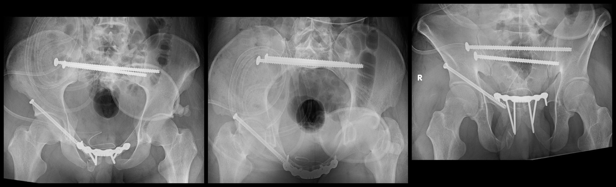 Pelvic Ring Fixation