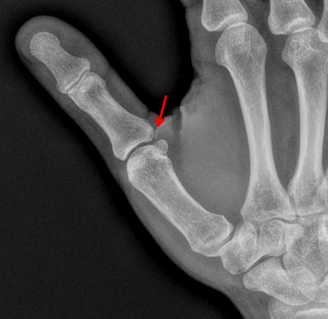 Avulsion Fracture And Ligament Damage Of The Right Thumb With 318