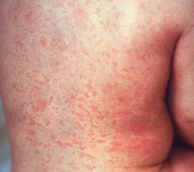 Rubella eliminated Canada News