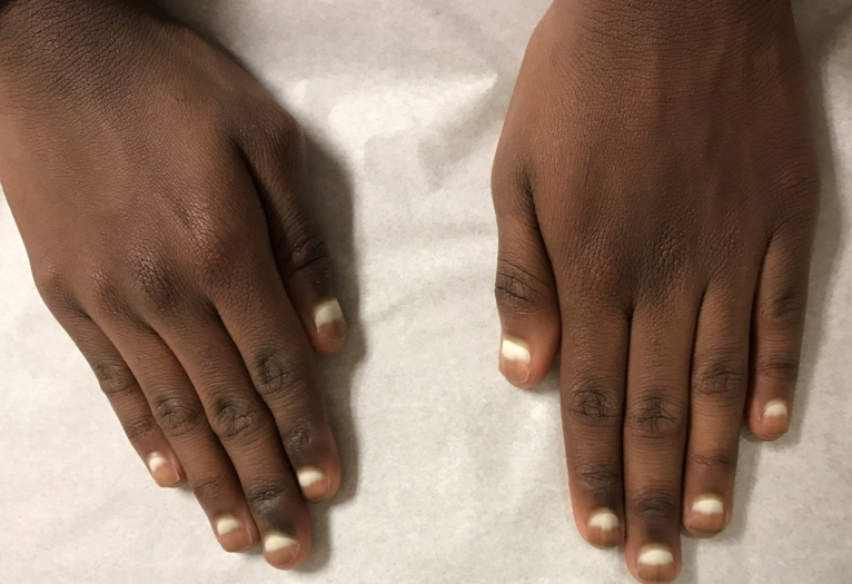 The Skin and kidney disease Cate Mimi Health Related Blog