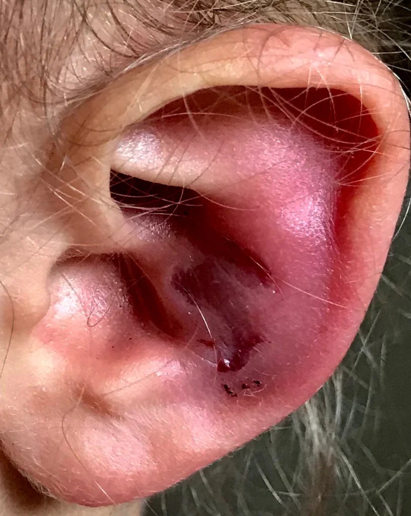 Over the counter for Cauliflower Ear. Too good to be true and