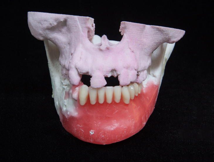 Restoring the Jaw of Shotgun Victim Cavendish Imaging