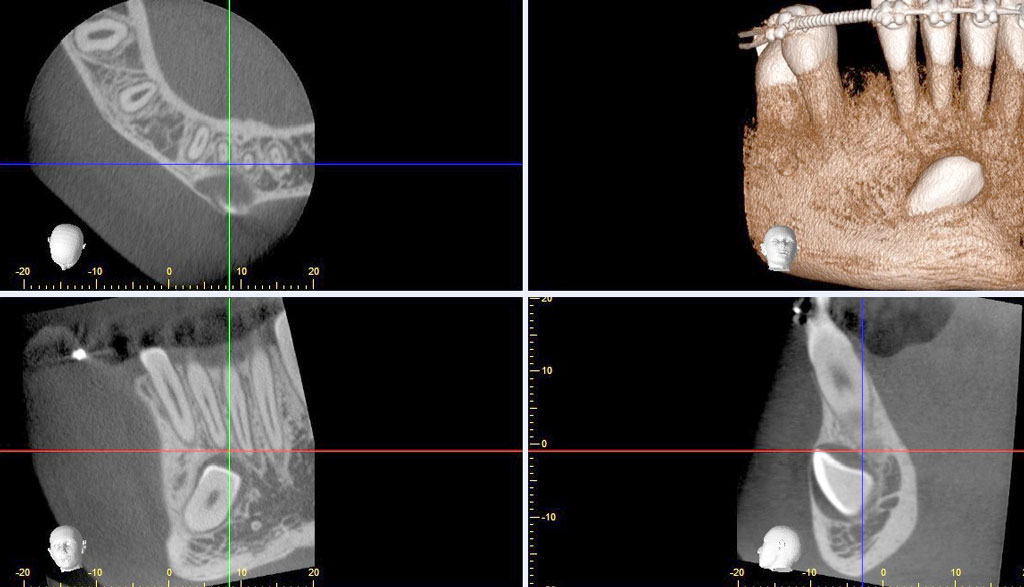 CBCT for Dentistry Optimised Exposures for Accurate Diagnosis