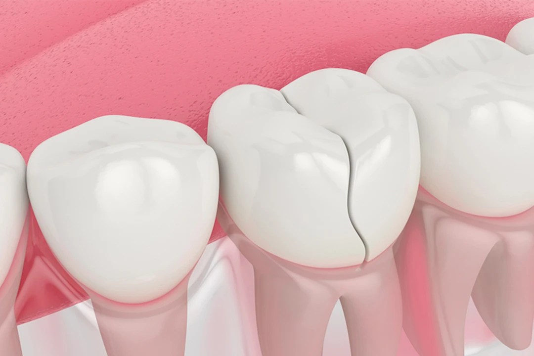 Cracked Teeth Dr. Christian Chung, D.D.S.