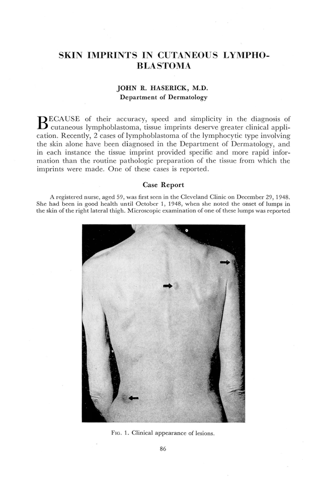 Skin Imprints in Cutaneous Lymphoblastoma Cleveland Clinic Journal of