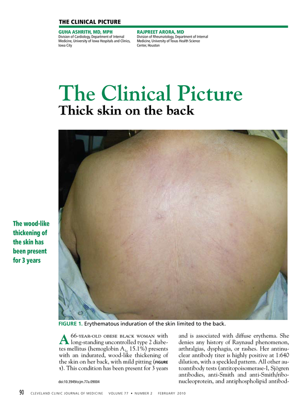 Thick skin on the back Cleveland Clinic Journal of Medicine
