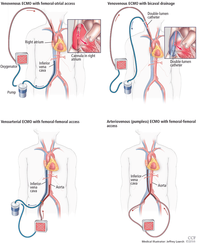 Extracorporeal membrane oxygenation in adults A practical guide for internists Cleveland