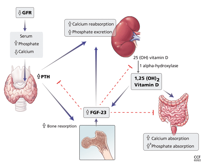 Extraosseous calcification in kidney disease Cleveland Clinic Journal