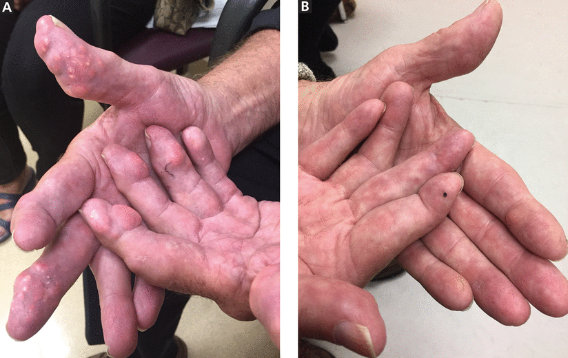 Finger nodules Tip of the gouty iceberg Cleveland Clinic Journal of