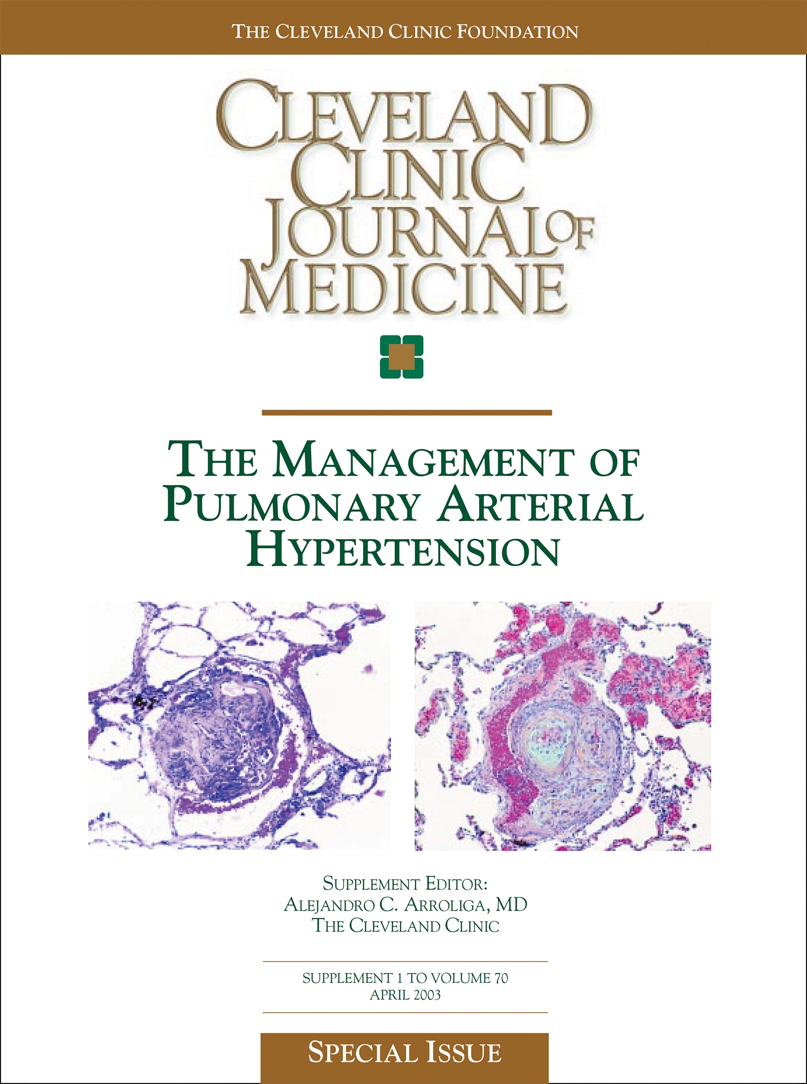 Primary pulmonary hypertension An overview of epidemiology and