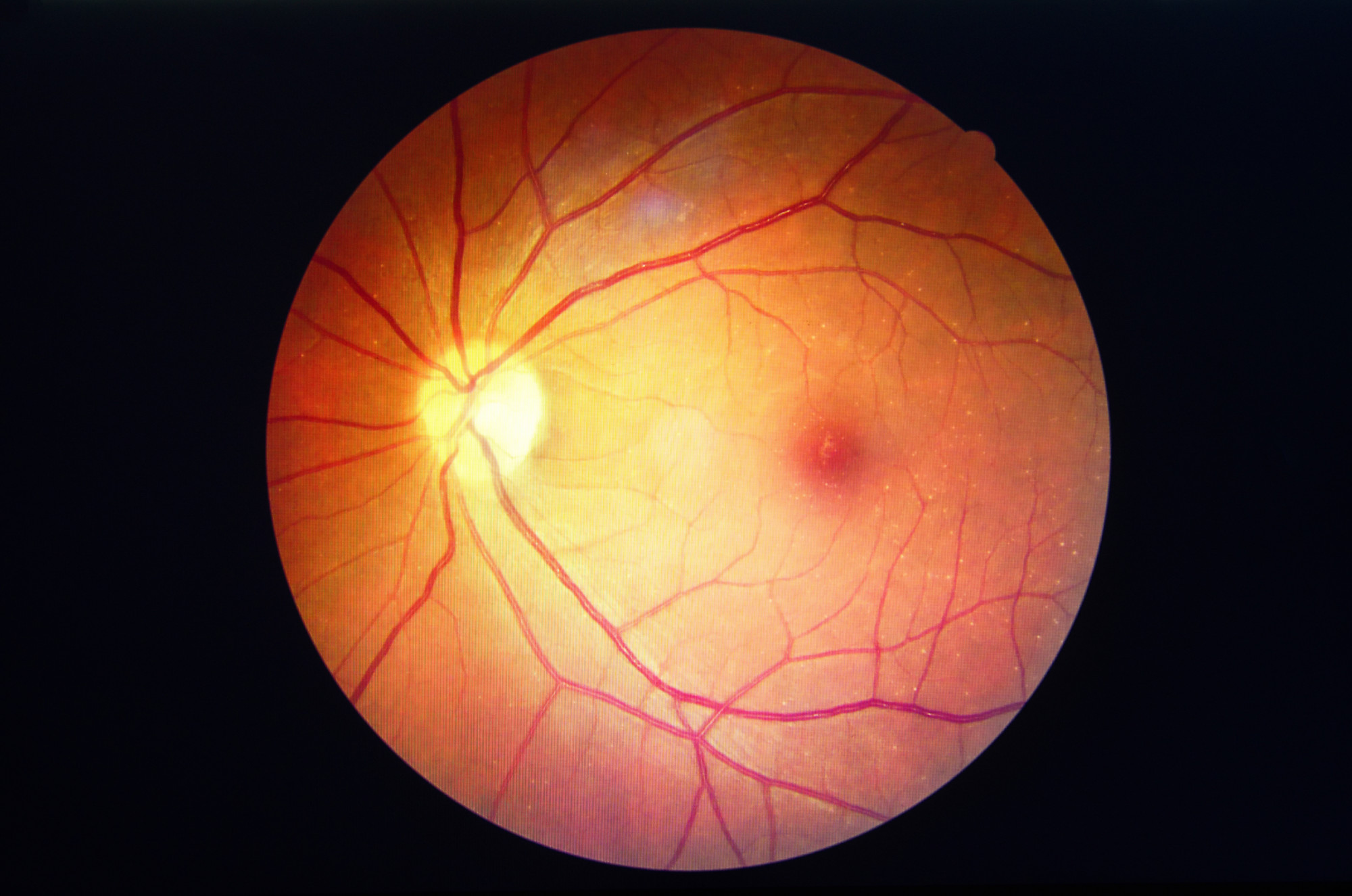 Macular Hole Vision