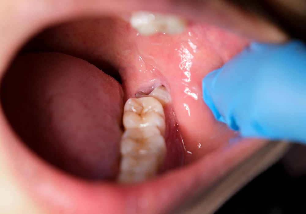 When Can I Eat Chips After Wisdom Teeth Removal? (When And What To Eat)