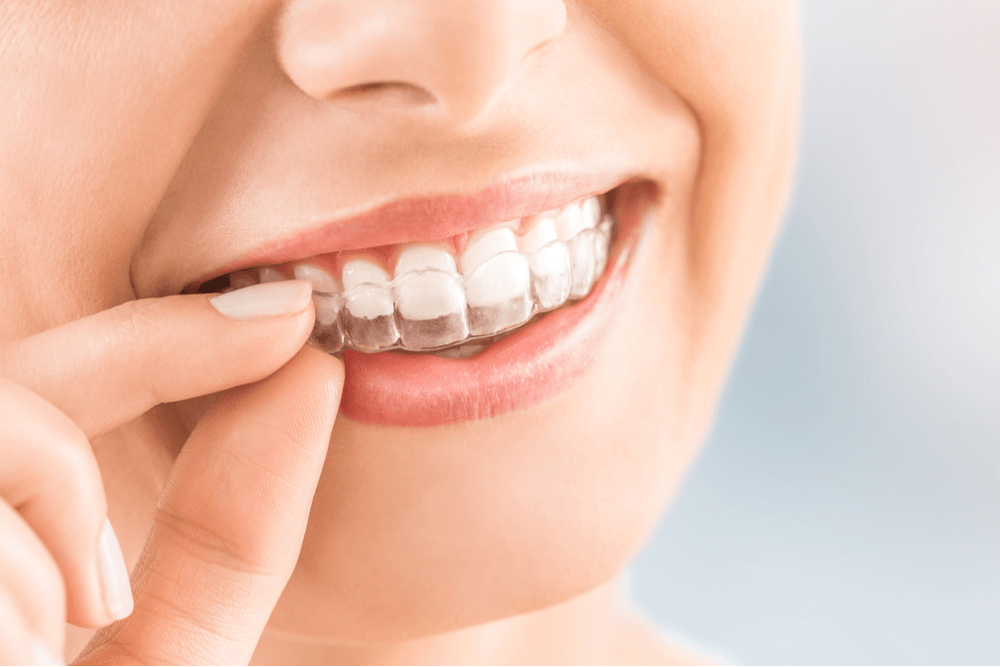 What are the Benefits of Invisalign? Dental Blog