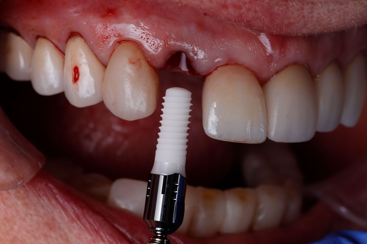 About Dental Implantology Center of Excellence