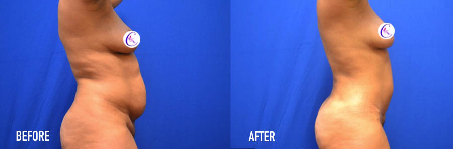 Mini Tuck with Liposuction of Upper and Lower Abdomen, anterior
