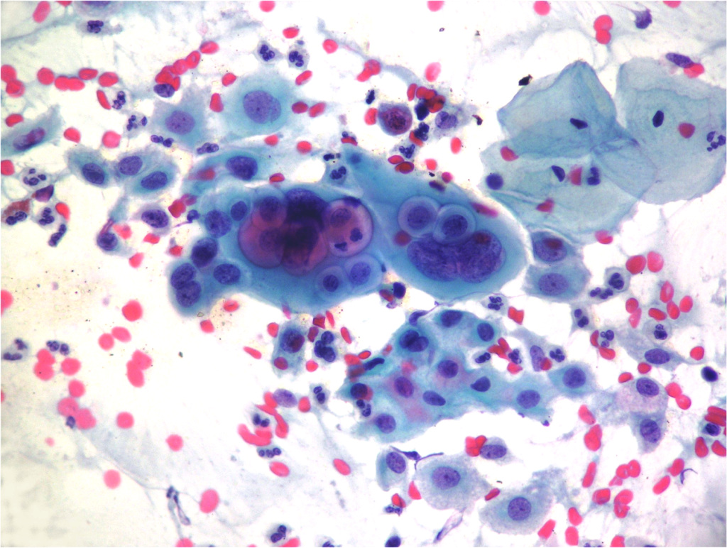 Diagnostic of cervical pathology. Pap smear. Pap test