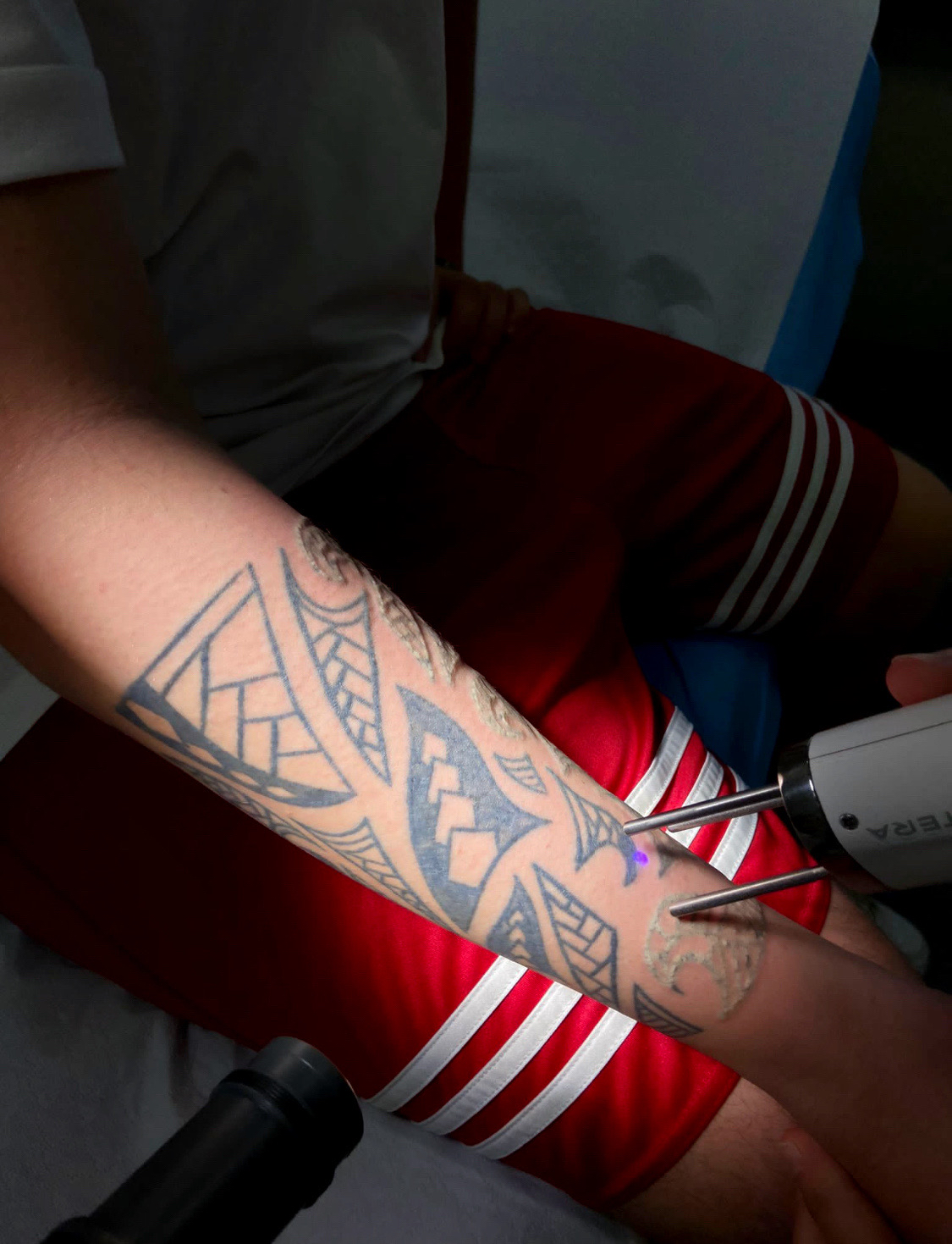 Rimozione Tatuaggi Napoli - Centro Keiron - Trattamenti Laser 1469_x_1125_jpg