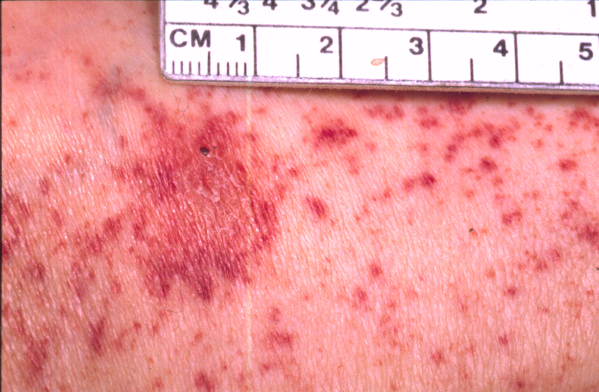 Rocky Mountain Spotted Fever « Disease Images « CFSPH
