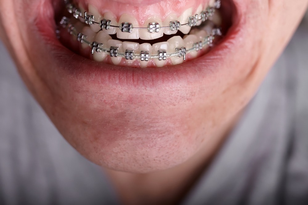 Mount Pleasant Orthodontist Adult Braces Invisalign