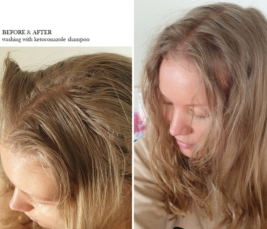 Scalp Problems, Seborrheic Dermatitis & The Curly Girl Method - Charlotta Eve