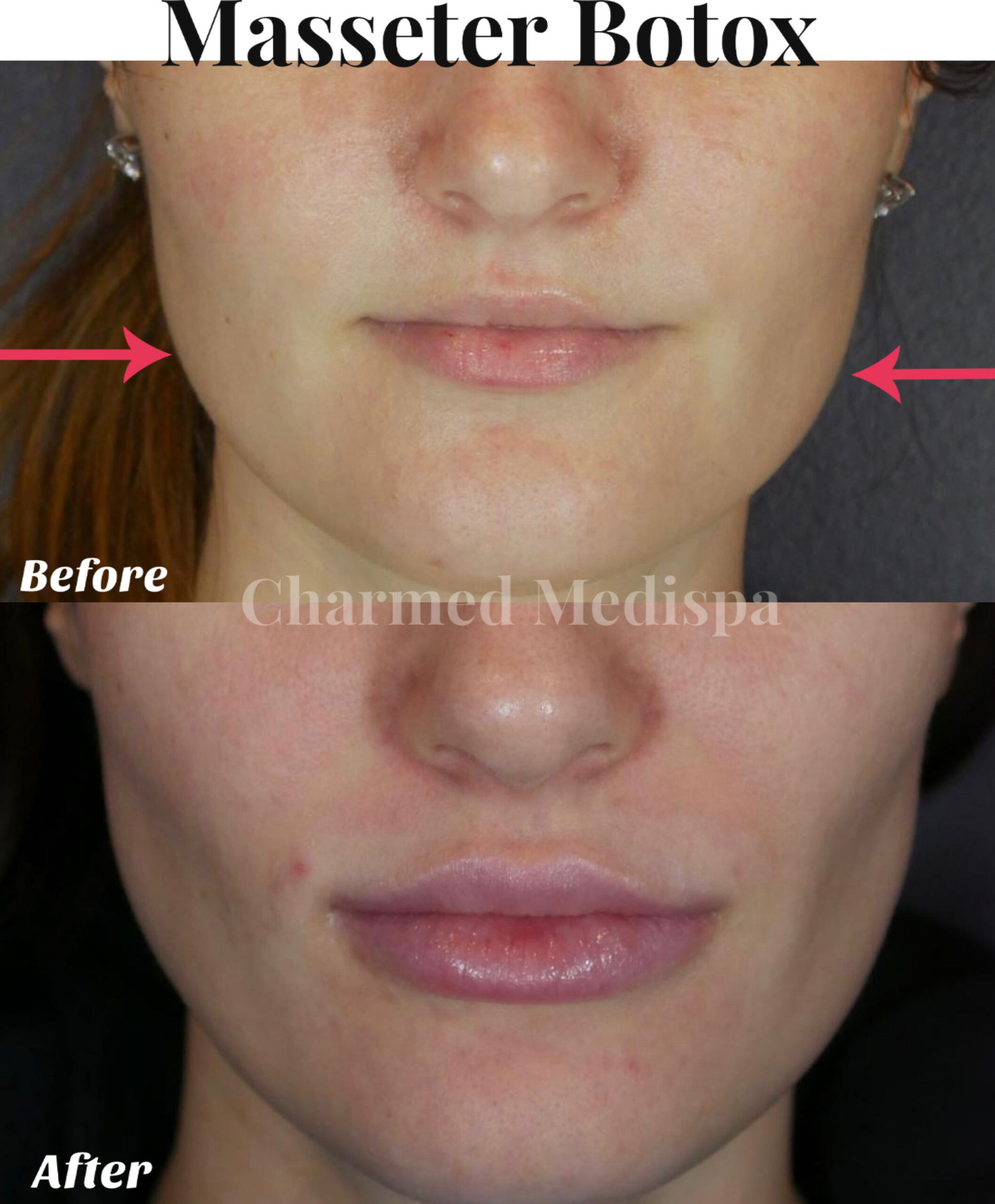 Achieving Facial Harmony and Relief Masseter Botox at Charmed Medispa