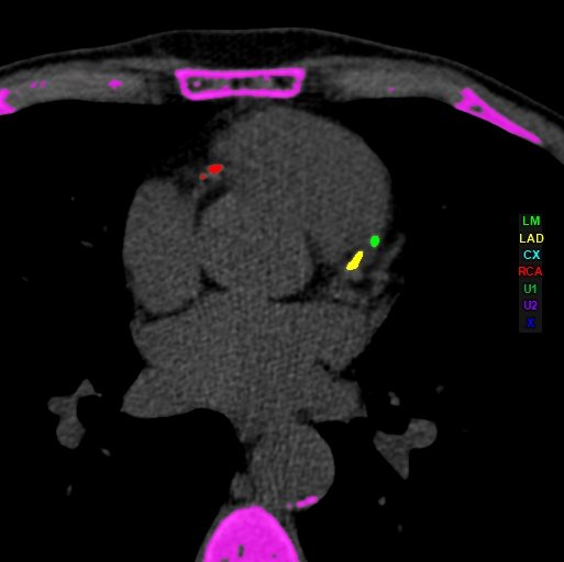 CT Cardiac Calcium Score Maryland Radiologist Charter Radiology