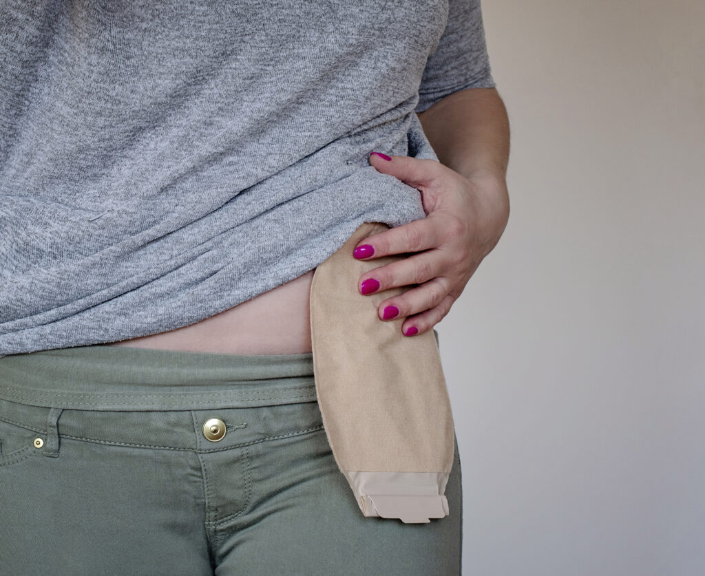 How to Help Irritated Skin Around the Stoma CHC Solutions