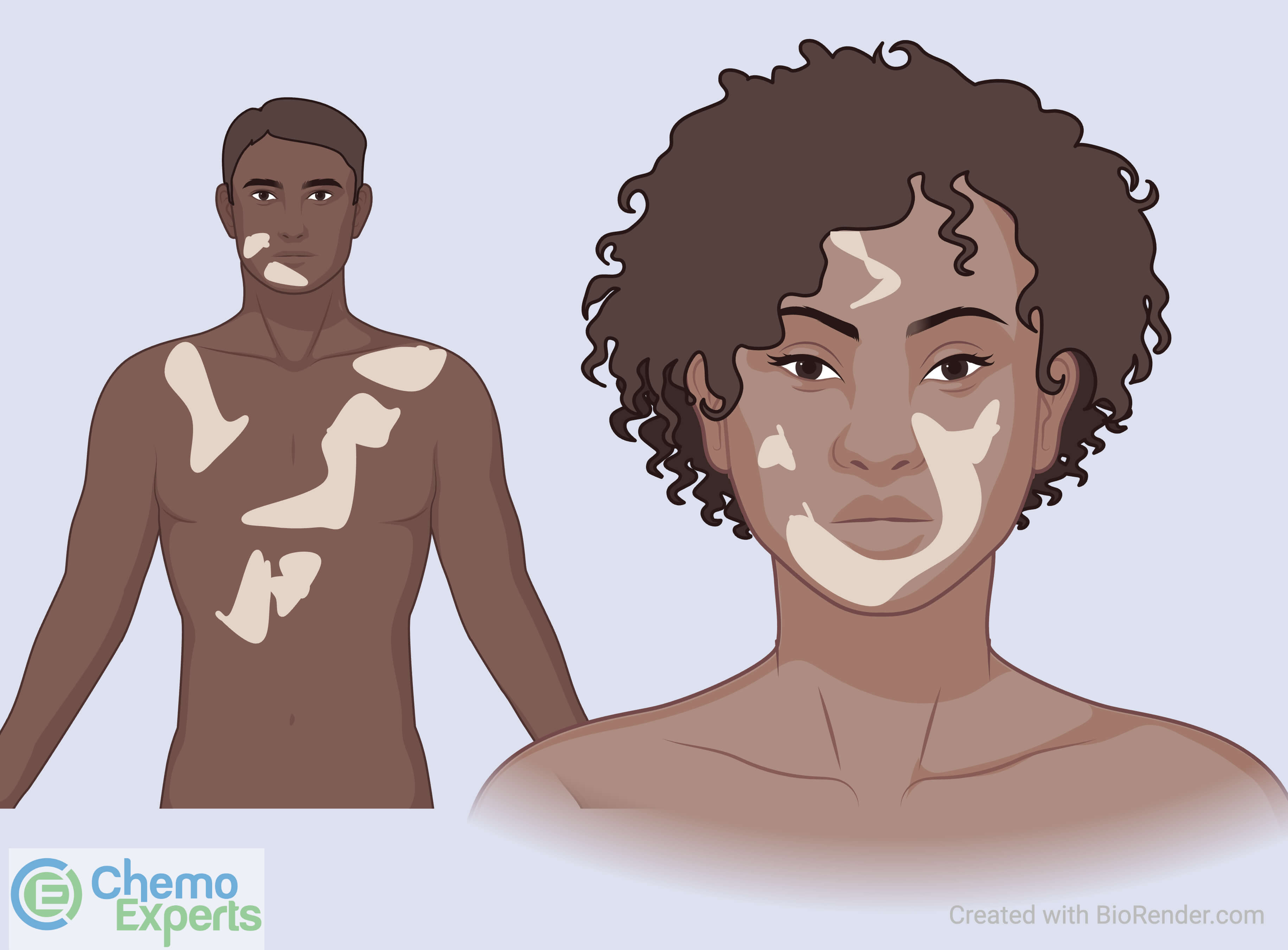 Loss of Pigmentation (Vitiligo) ChemoExperts