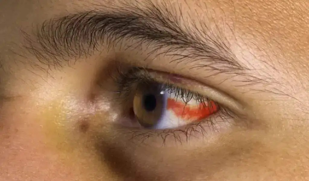 Symptoms Of Eye Bleeding, Their Causes, And How To Treat Them CTN News