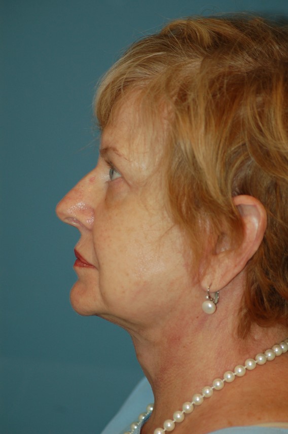 JB LL after The Center for Facial Plastic Surgery