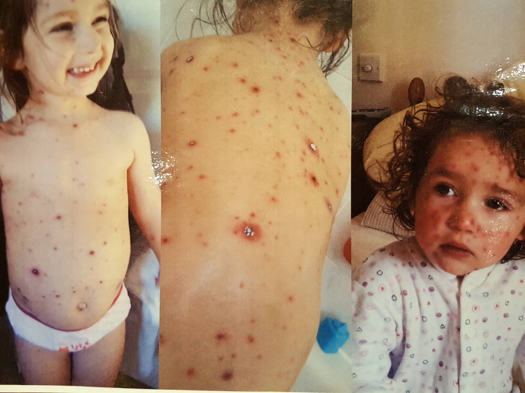 My child has chicken pox for the second time Child Matters