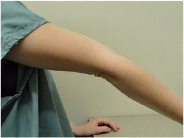 Figure 7. Left thumb hypermobility.