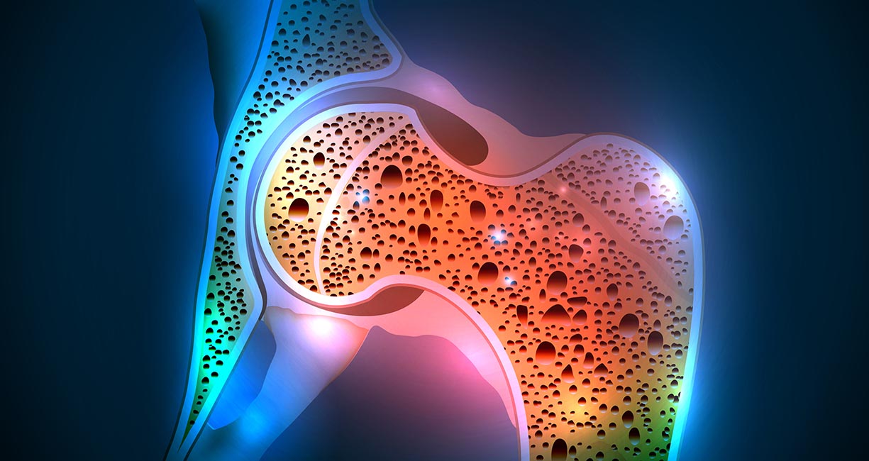 Does your patient have low bone density? Why to utilize DXA scanning