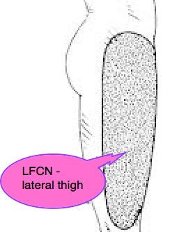 An lfcn block with 8 ml of 0.75 % ropivacaine followed after 45 mins by an additional lfcn block with 8 ml of saline. Lateral femoral cutaneous nerve supplies the skin of the ...