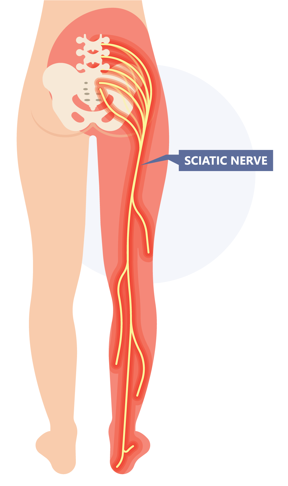 Sciatica How to treat that radiating leg pain Chiropractic Singapore