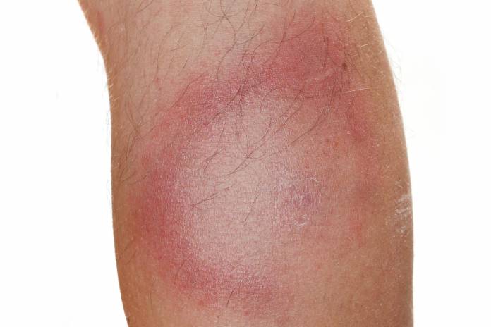 LymeBorreliose Borreliose