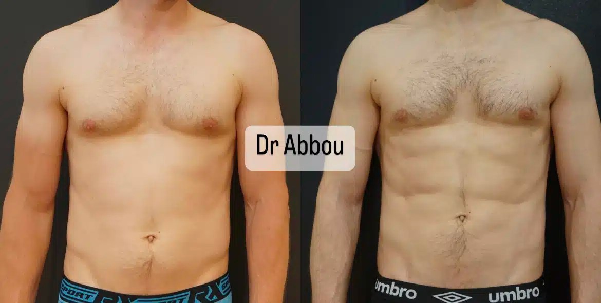 Abdominal Etching Cost