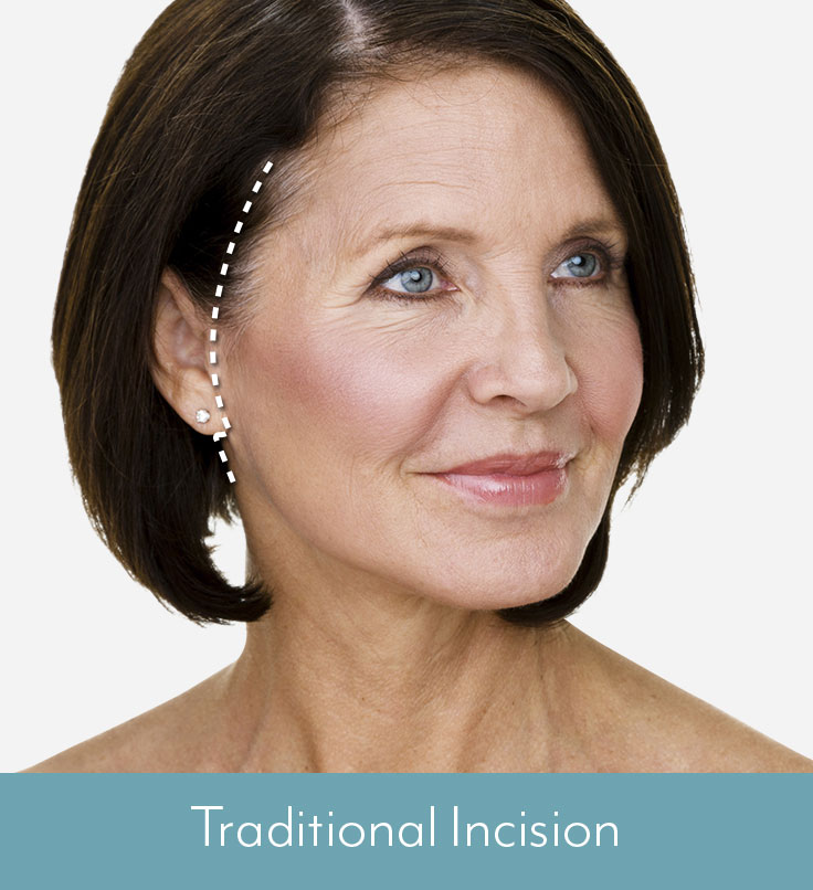 Facelift & Mini Facelift for Boston & Wellesley, MA Dr. Christopher J