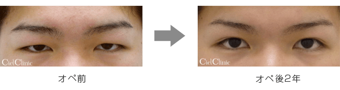 二重ですがまぶたが厚いです。痩せています。薄くするいい方法が... - Yahoo!知恵袋 まぶたを薄く | 六本木 シエルクリニック【公式】ミッドタウン六本木近く 鼻孔縁形成（小鼻形成）・眉下切開