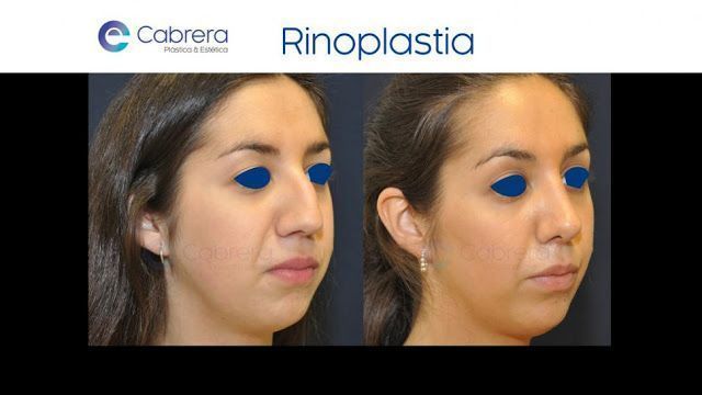 Rinoplastia ¿Qué es una nariz atractiva y cómo conseguirla?